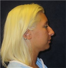 Rhinoplasty Before Photo by Pramit Malhotra, MD; Ann Arbor, MI - Case 35695