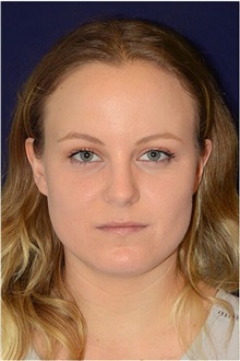 Dermal Fillers Before Photo by Michael Law, MD; Raleigh, NC - Case 35741