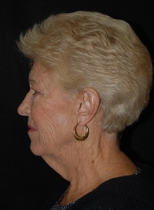 Facelift Before Photo by Robert Kessler, MD; Corona Del Mar, CA - Case 35783