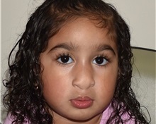 Cleft Lip and Palate Repair After Photo by Rachel Ruotolo, MD; Garden City, NY - Case 36039