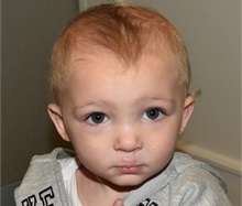 Cleft Lip and Palate Repair After Photo by Rachel Ruotolo, MD; Garden City, NY - Case 36065