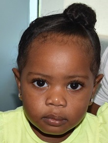 Cleft Lip and Palate Repair After Photo by Rachel Ruotolo, MD; Garden City, NY - Case 36070