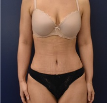 Liposuction After Photo by Richard Reish, MD, FACS; New York, NY - Case 36236