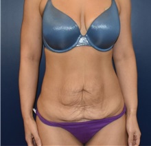 Liposuction Before Photo by Richard Reish, MD, FACS; New York, NY - Case 36236
