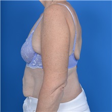 Arm Lift After Photo by Jonathan Weinrach, MD; ,  - Case 36767