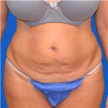 Tummy Tuck Before Photo by Jonathan Weinrach, MD; ,  - Case 36780