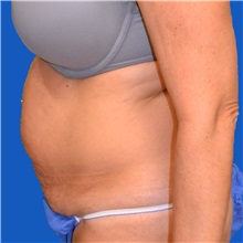 Tummy Tuck Before Photo by Jonathan Weinrach, MD; ,  - Case 36780