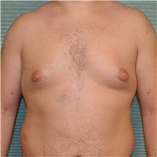 Male Breast Reduction Before Photo by Jonathan Weinrach, MD; ,  - Case 36846