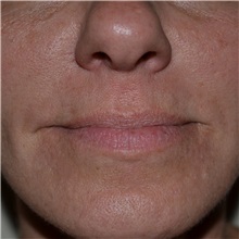Dermal Fillers After Photo by Jonathan Weinrach, MD; ,  - Case 36861
