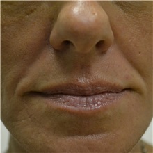 Dermal Fillers Before Photo by Jonathan Weinrach, MD; ,  - Case 36861