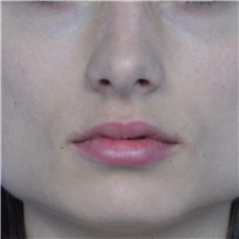 Lip Augmentation/Enhancement Before Photo by Jonathan Weinrach, MD; ,  - Case 36863