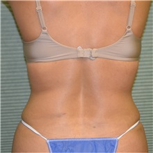 Liposuction After Photo by Jonathan Weinrach, MD; ,  - Case 36868