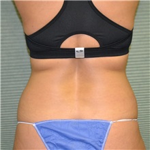 Liposuction Before Photo by Jonathan Weinrach, MD; ,  - Case 36868