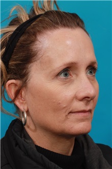 Brow Lift Before Photo by Michael Bogdan, MD, MBA, FACS; Grapevine, TX - Case 36906