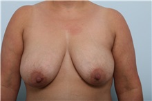 Breast Lift Before Photo by Paul Vitenas, Jr., MD; Houston, TX - Case 36939