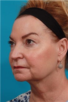 Facelift Before Photo by Michael Bogdan, MD, MBA, FACS; Grapevine, TX - Case 37047