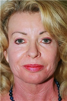 Facelift After Photo by Steve Laverson, MD, FACS; Rancho Santa Fe, CA - Case 37390