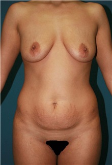Body Contouring Before Photo by Marvin Shienbaum, MD; Brandon, FL - Case 37507