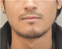 Chin Augmentation After Photo by Keshav Magge, MD; Bethesda, MD - Case 37519