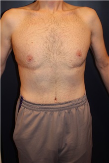 Body Contouring After Photo by Larry Weinstein, MD; Chester, NJ - Case 37554