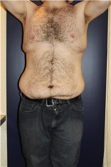 Body Contouring Before Photo by Larry Weinstein, MD; Chester, NJ - Case 37554