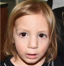 Cleft Lip and Palate Repair After Photo by Rachel Ruotolo, MD; Garden City, NY - Case 37795