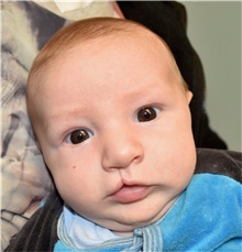 Cleft Lip and Palate Repair Before Photo by Rachel Ruotolo, MD; Garden City, NY - Case 37795