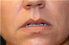 Lip Augmentation/Enhancement Before Photo by Steve Laverson, MD, FACS; Rancho Santa Fe, CA - Case 37922