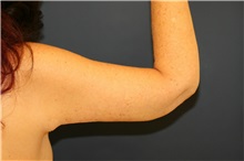 Arm Lift After Photo by Steve Laverson, MD, FACS; Rancho Santa Fe, CA - Case 38062