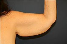 Arm Lift Before Photo by Steve Laverson, MD, FACS; Rancho Santa Fe, CA - Case 38062