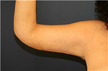 Arm Lift After Photo by Steve Laverson, MD, FACS; Rancho Santa Fe, CA - Case 38062