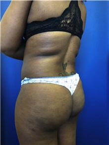 Buttock Lift with Augmentation Before Photo by Mark Markarian, MD, MSPH, FACS; Wellesley, MA - Case 38063