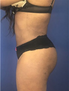 Buttock Lift with Augmentation After Photo by Mark Markarian, MD, MSPH, FACS; Wellesley, MA - Case 38063