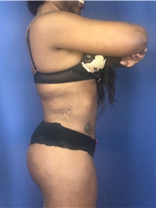 Buttock Lift with Augmentation After Photo by Mark Markarian, MD, MSPH, FACS; Wellesley, MA - Case 38063