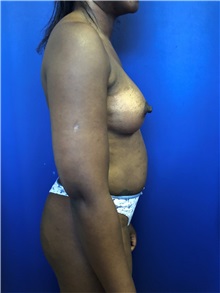 Buttock Lift with Augmentation Before Photo by Mark Markarian, MD, MSPH, FACS; Wellesley, MA - Case 38063