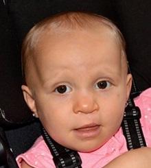 Cleft Lip and Palate Repair After Photo by Rachel Ruotolo, MD; Garden City, NY - Case 38097