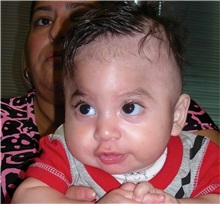 Craniosynostosis Before Photo by Rachel Ruotolo, MD; Garden City, NY - Case 38129