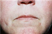 Lip Augmentation/Enhancement Before Photo by Steve Laverson, MD, FACS; Rancho Santa Fe, CA - Case 38604