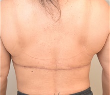 Body Contouring After Photo by Keshav Magge, MD; Bethesda, MD - Case 38640