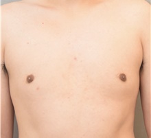 Male Breast Reduction After Photo by Keshav Magge, MD; Bethesda, MD - Case 38642