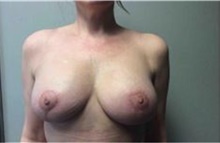 Breast Implant Removal After Photo by Mariam Awada, MD, FACS; ,  - Case 38836