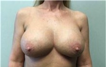 Breast Implant Removal After Photo by Mariam Awada, MD, FACS; ,  - Case 38838
