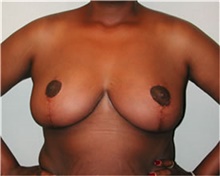 Breast Reduction After Photo by Mariam Awada, MD, FACS; ,  - Case 38860