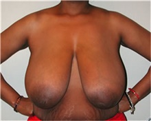 Breast Reduction Before Photo by Mariam Awada, MD, FACS; ,  - Case 38860