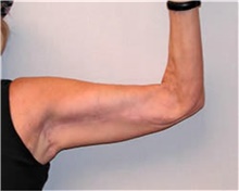 Arm Lift After Photo by Mariam Awada, MD, FACS; ,  - Case 38868