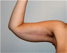 Arm Lift After Photo by Mariam Awada, MD, FACS; ,  - Case 38870