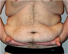 Body Lift Before Photo by Mariam Awada, MD, FACS; ,  - Case 38876