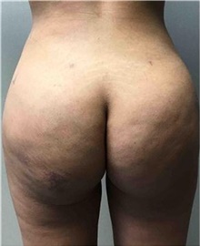 Buttock Lift with Augmentation After Photo by Mariam Awada, MD, FACS; ,  - Case 38889
