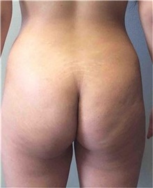 Buttock Lift with Augmentation Before Photo by Mariam Awada, MD, FACS; ,  - Case 38889