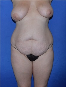 Tummy Tuck Before Photo by Karol Gutowski, MD, FACS; Glenview, IL - Case 39116